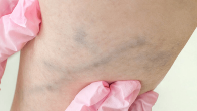 Facts About Spider Veins