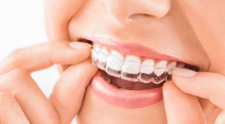 Benefits Of Invisalign Over Traditional Braces